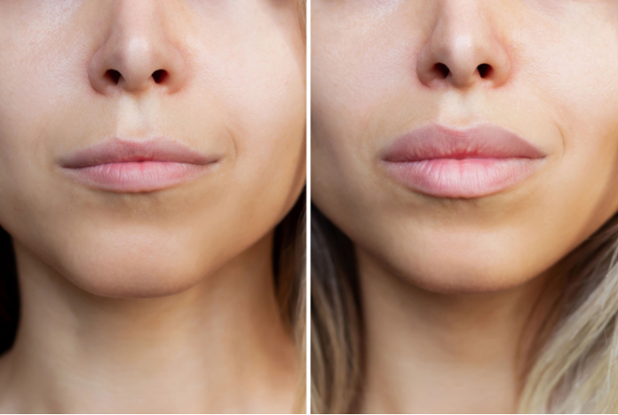 stylage filler