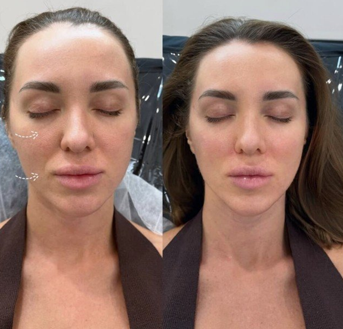 eye bag injections cost