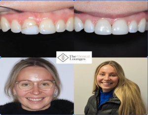 Composite Bonding in Wimbledon

